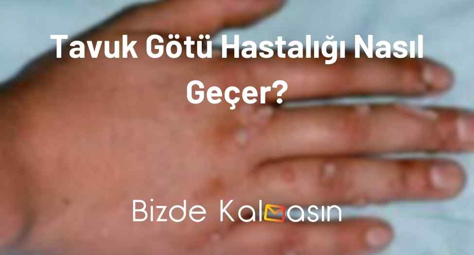 Tavuk Götü Hastalığı Nasıl Geçer?