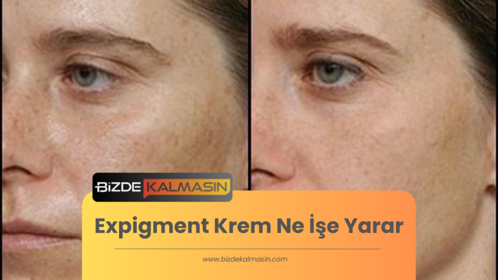 Expigment Krem Ne İşe Yarar