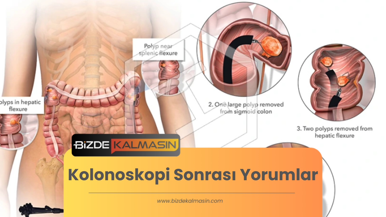 Kolonoskopi Sonrası Yorumlar - Devlet Hastanesinde Kolonoskopi Kolonoskopi Sonrası Yorumlar
