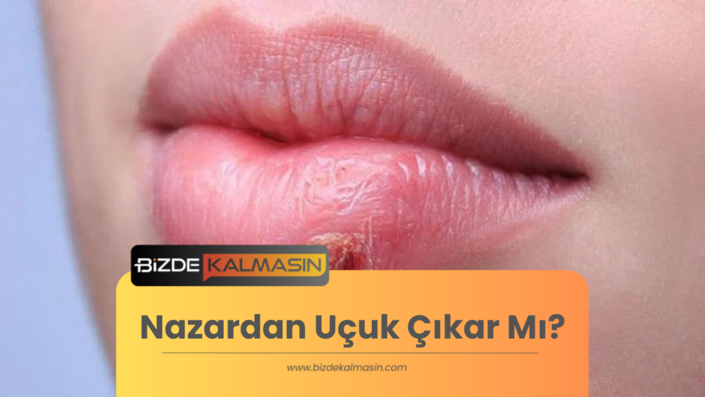 Nazardan Uçuk Çıkar Mı?