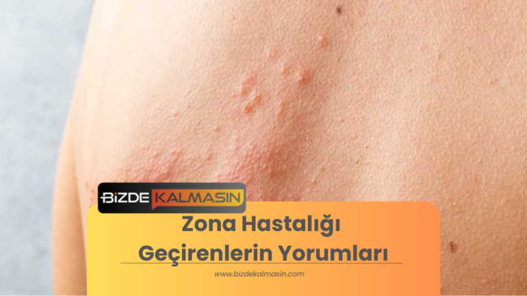 Zona Hastalığı Geçirenlerin Yorumları