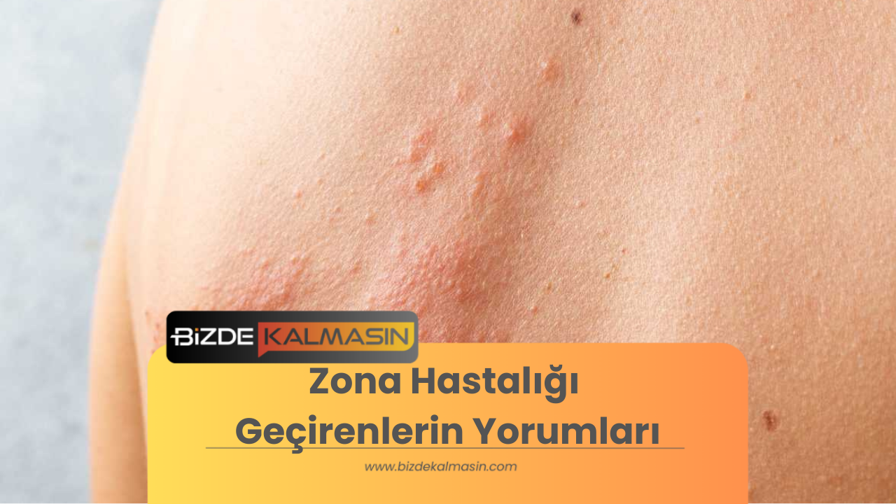 Zona Hastalığı Geçirenlerin Yorumları - En İyi Zona Kremi Zona Hastalığı Geçirenlerin Yorumları