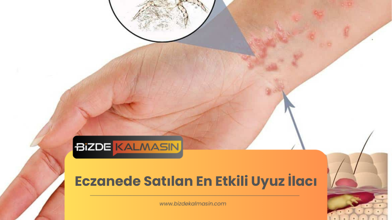 Eczanede Satılan En Etkili Uyuz İlacı 2023 - İsimleri Ve Fiyatları Eczanede Satılan En Etkili Uyuz İlacı