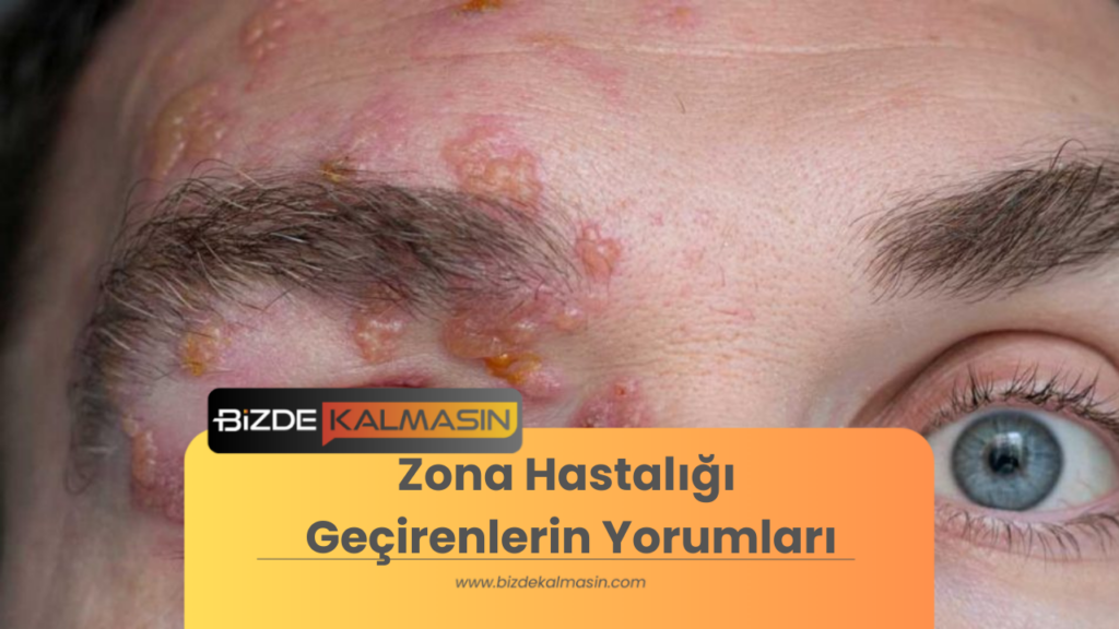 Zona Hastalığı Geçirenlerin Yorumları