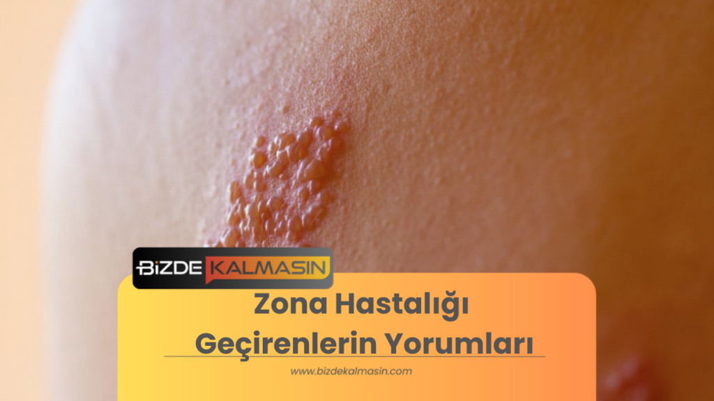 Zona Hastalığı Geçirenlerin Yorumları