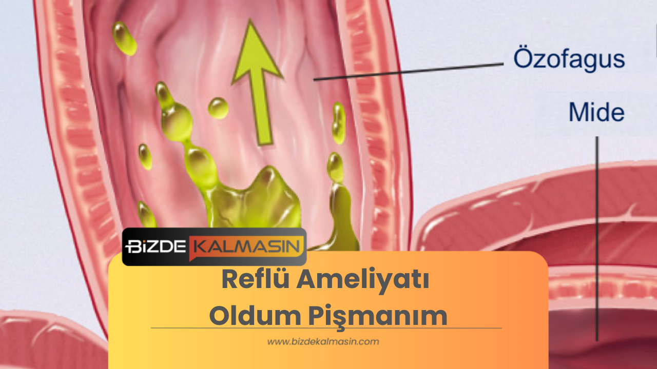 Reflü Ameliyatı Oldum Pişmanım -Nedenleri ve Öneriler Reflü Ameliyatı Oldum Pişmanım