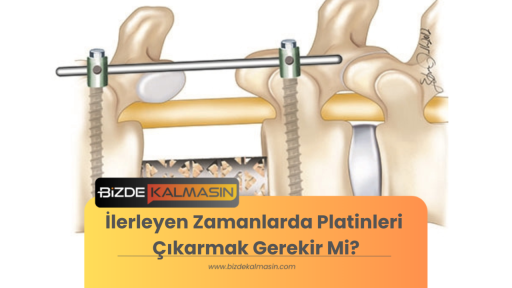 İlerleyen Zamanlarda Platinleri Çıkarmak Gerekir Mi?