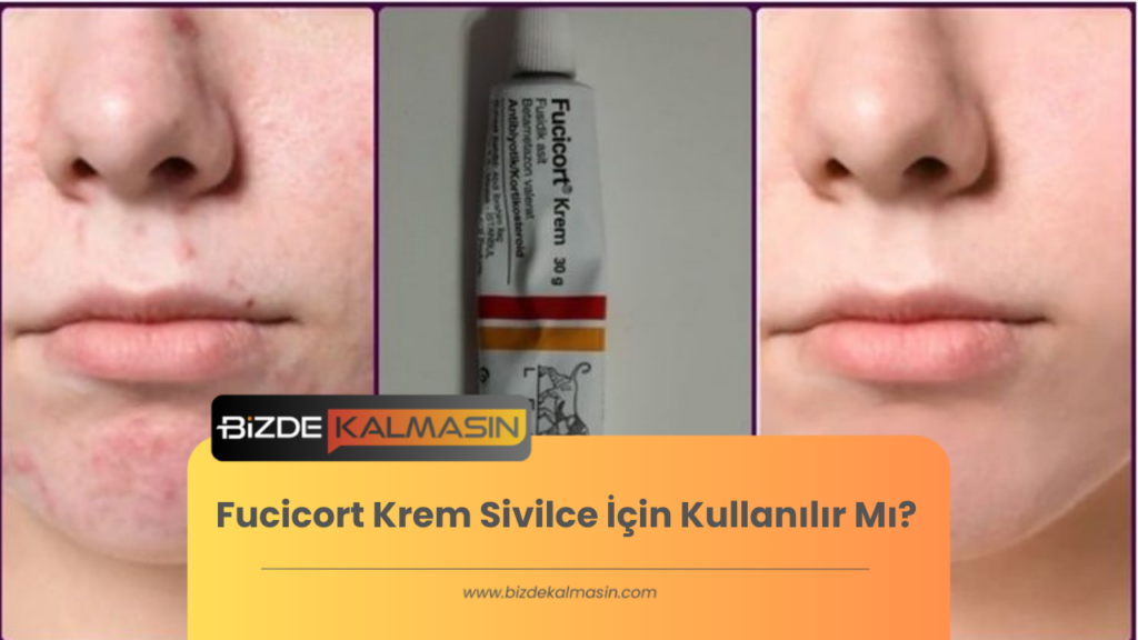 Fucicort Krem Sivilce İçin Kullanılır Mı?