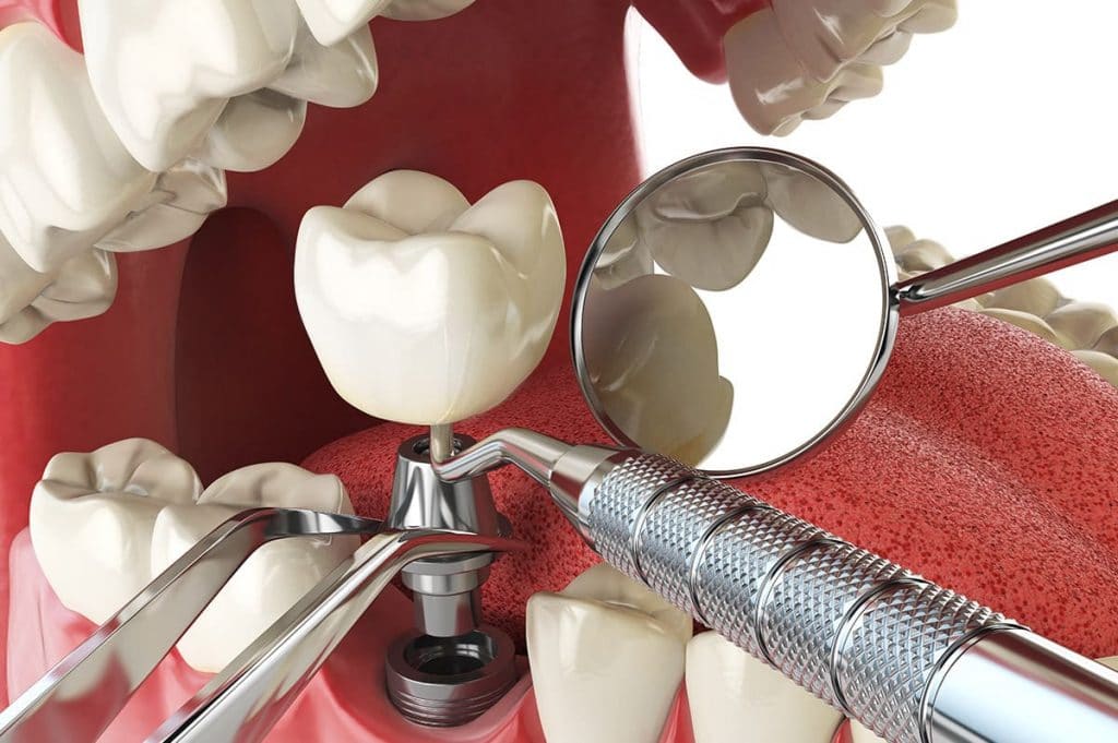 Dental Implant Tedavisi Hakkında Bilgi