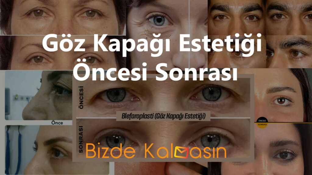 Ankara Göz Kapağı Estetiği - Doktorları ve Yaptıranların Yorumları Göz Kapağı Estetiği Öncesi Sonrası