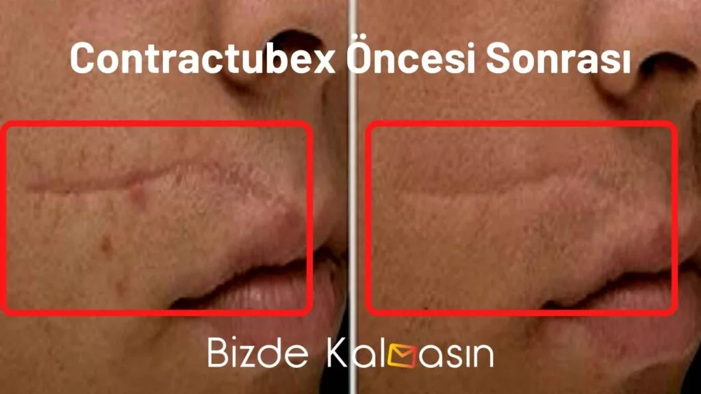 Contractubex Öncesi Sonrası