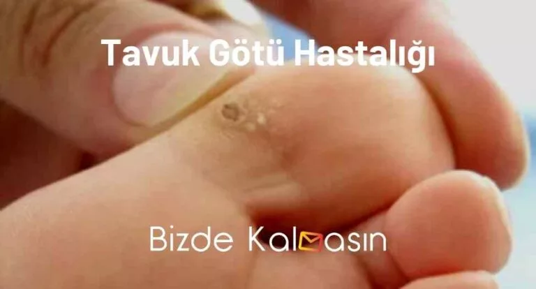 Tavuk Götü Hastalığı Nasıl Geçer?