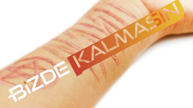 Koldaki Jilet İzi Nasıl Geçer Doğal Yolla ?